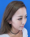 その方の本来の美しさを引き出すプチ整形・　二重術＆アゴ・鼻