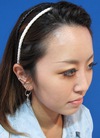 その方の本来の美しさを引き出すプチ整形・　二重術＆アゴ・鼻