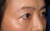 DR.近藤　こだわりの眉毛下切開による　目の上のたるみとり