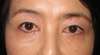 DR.近藤　こだわりの眉毛下切開による　目の上のたるみとり