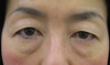 DR.近藤　こだわりの眉毛下切開による　目の上のたるみとり