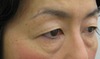 DR.近藤　こだわりの眉毛下切開による　目の上のたるみとり