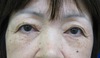 DR.近藤　こだわりの眉毛下切開による　目の上のたるみとり（他院術後　修正）