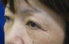 DR.近藤　こだわりの眉毛下切開による　目の上のたるみとり（他院術後　修正）