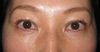 DR.近藤オリジナル　切らない　目の下のくま・たるみとり　 自己再生TCB