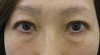 DR.近藤オリジナル　切らない　目の下のくま・たるみとり　 自己再生TCB