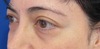 目の下のクマ・たるみでお悩みの方に（膨らみと凹みが混在した方）DR.近藤オリジナル　切らない目の下のクマ・たるみとり　自己再生TCB-R法　