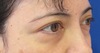 目の下のクマ・たるみでお悩みの方に（膨らみと凹みが混在した方）DR.近藤オリジナル　切らない目の下のクマ・たるみとり　自己再生TCB-R法　