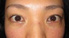 DR   近藤オリジナル　切らない目の下のクマ・たるみとり　（マイクロサージャリー）術直後写真