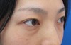 目の下のクマ・たるみでお悩みの方へ（膨らみと凹みの混在した方）：DR近藤オリジナル　TCB-R