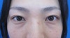 目の下のクマ・たるみでお悩みの方へ（膨らみと凹みの混在した方）：DR近藤オリジナル　TCB-R