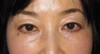目の下の膨らみと凹みが混在した方に：DR近藤オリジナル　切らない目の下のクマ・たるみとり　+　ラディエッセ注入（TCB-R法） 術3ヶ月後写真