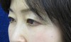目の下の膨らみと凹みが混在した方に：DR近藤オリジナル　切らない目の下のクマ・たるみとり　+　ラディエッセ注入（TCB-R法） 術3ヶ月後写真