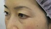 目の下の膨らみと凹みが混在した方に：DR近藤オリジナル　切らない目の下のクマ・たるみとり　+　ラディエッセ注入（TCB-R法） 術3ヶ月後写真