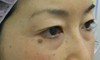 目の下の膨らみと凹みが混在した方に：DR近藤オリジナル　切らない目の下のクマ・たるみとり　+　ラディエッセ注入（TCB-R法） 術3ヶ月後写真