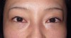 DR   近藤オリジナル　切らない目の下のクマ・たるみとり　（マイクロサージャリー）術直後写真