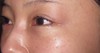 DR 近藤オリジナル　切らない目の下のクマ・たるみとり（マイクロサージャリー）　術直後写真