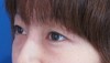 DR 近藤オリジナル　切らない目の下のクマ・たるみとり（マイクロサージャリー）　術直後写真