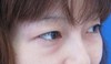 DR   近藤オリジナル　切らない目の下のクマ・たるみとり　（マイクロサージャリー）術直後写真