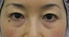 目の下の膨らみと凹みが混在した方に：DR近藤オリジナル　切らない目の下のクマ・たるみとり　+　ラディエッセ注入（TCB-R法） 術3ヶ月後写真