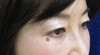 目の下の膨らみと凹みが混在した方に：DR近藤オリジナル　切らない目の下のクマ・たるみとり　+　ラディエッセ注入（TCB-R法） 術3ヶ月後写真