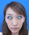 DR.近藤　こだわりのプチ整形　鼻・ゴルゴライン（チーク）へのラディエッセ注入