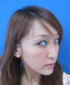DR.近藤　こだわりのプチ整形　鼻・ゴルゴライン（チーク）へのラディエッセ注入