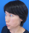 自分の血液から作るゲルで素敵に若返り！　PPP-GEL注入療法　plus ラディエッセ注入　（チーク　頬　法令線　+　アゴ　目の下）直後写真