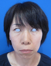 自分の血液から作るゲルで素敵に若返り！　PPP-GEL注入療法　plus ラディエッセ注入　（チーク　頬　法令線　+　アゴ　目の下）直後写真