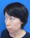 自分の血液から作るゲルで素敵に若返り！　PPP-GEL注入療法　plus ラディエッセ注入　（チーク　頬　法令線　+　アゴ　目の下）直後写真