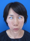 自分の血液から作るゲルで素敵に若返り！　PPP-GEL注入療法　plus ラディエッセ注入　（チーク　頬　法令線　+　アゴ　目の下）直後写真