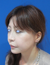 DR.近藤オリジナル　切らないお顔の引き上げ術　チタンペックリフト　長期経過写真