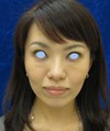手術でなくても　ほんの数分で　こんなに綺麗になれます！DR近藤　こだわりの　ラディエッセ注入　（ゴルゴライン　アゴ）