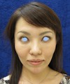 手術でなくても　ほんの数分で　こんなに綺麗になれます！DR近藤　こだわりの　ラディエッセ注入　（ゴルゴライン　アゴ）