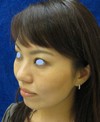 手術でなくても　ほんの数分で　こんなに綺麗になれます！　DR近藤　こだわりの　ラディエッセ注入　（ゴルゴライン　アゴ）