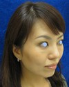 手術でなくても　ほんの数分で　こんなに綺麗になれます！　DR近藤　こだわりの　ラディエッセ注入　（ゴルゴライン　アゴ）