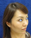 手術でなくても　ほんの数分で　こんなに綺麗になれます！　DR近藤　こだわりの　ラディエッセ注入　（ゴルゴライン　アゴ）