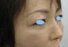 ゴルゴライン・目の下の凹み・小じわに　お悩みの方に　DR近藤　こだわりのラディエッセ注入
