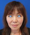 ゴルゴラインにお悩みの方に　DR.　近藤　こだわりのプチ整形　ラディエッセ注入　