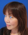 ゴルゴラインにお悩みの方に　DR.　近藤　こだわりのプチ整形　ラディエッセ注入　