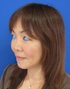 ゴルゴラインにお悩みの方に　DR.　近藤　こだわりのプチ整形　ラディエッセ注入　
