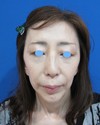 ご自身の血液から作るPPP-GEL（プラズマジェル）で　ふっくら若返り！　PPP-GEL注入療法