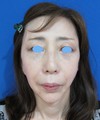 ご自身の血液から作るPPP-GEL（プラズマジェル）で　ふっくら若返り！　PPP-GEL注入療法