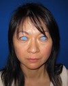 DR 近藤オリジナル　切らないお顔の引き上げ術　チタンペックリフト　術6週後