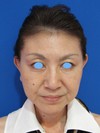 私の目指す美容外科・MIAS　最小侵襲美容外科/ DR.近藤オリジナル　切らないお顔の引き上げ術　チタンペックリフト