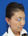 私の目指す美容外科・MIAS　最小侵襲美容外科/ DR.近藤オリジナル　切らないお顔の引き上げ術　チタンペックリフト