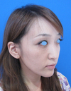DR.近藤　こだわりのプチ整形　鼻・ゴルゴライン（チーク）へのラディエッセ注入