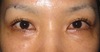 DR.近藤オリジナル　切らない　目の下のくま・たるみとり　（ 術直後写真）
