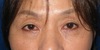 DR.近藤オリジナル　切らない　目の下のくま・たるみとり　 自己再生TCB   一年後写真