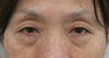 DR.近藤オリジナル　切らない　目の下のくま・たるみとり　 自己再生TCB   一年後写真